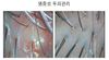 여성두피 염증성두피 3개월관리후기 