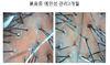 붉음증 예민성두피 3개월관리후기