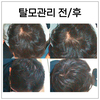 중년 남성 탈모관리 전 - 후