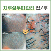 지루성두피관리 전/ 후
