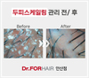 두피스케일링관리 전/ 후