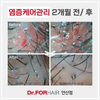 염증케어 전, 후 비교사진