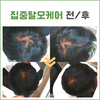 30대남성 탈모관리 전/후 비교