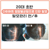 20대 초반 여성 탈모관리 전/후