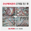 건선케어관리 2개월 전/ 후