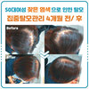 50세 여성탈모 4개월 집중탈모관리 전/ 후