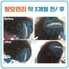 여성가르마탈모 약3개월관리