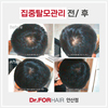 30대남성 집중탈모관리 전/ 후