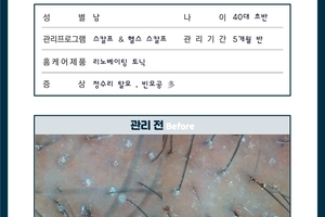 40대 남성 정수리 탈모 5개월 관리 후