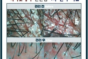 겹겹이 쌓인 각질 , 두피 가려움 , 통증 잡기