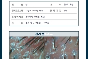 민감하고 가려운 두피 관리 7회 전 - 후