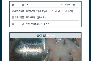 가르마 탈모 관리 5개월